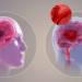 ischemic stroke, hemorrhagic stroke, impacts of stroke, blood clots, brain bleeds